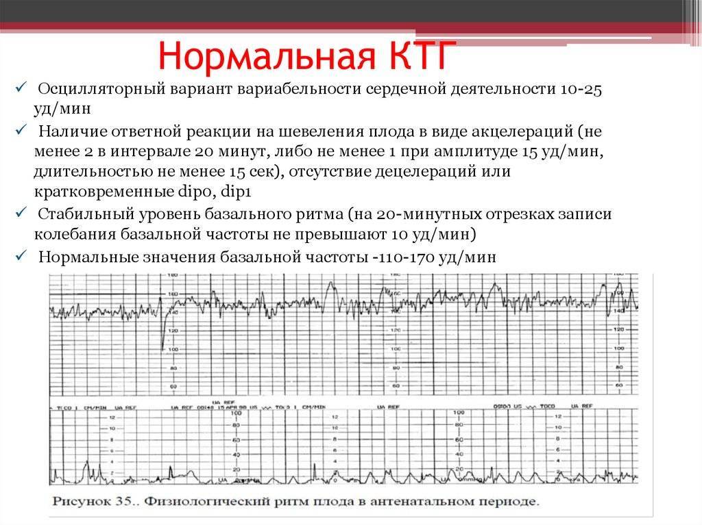 Признаки схваток на мониторе КТГ