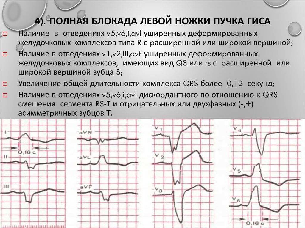 Неполная блокада правой ножки пучка Гиса у ребенка