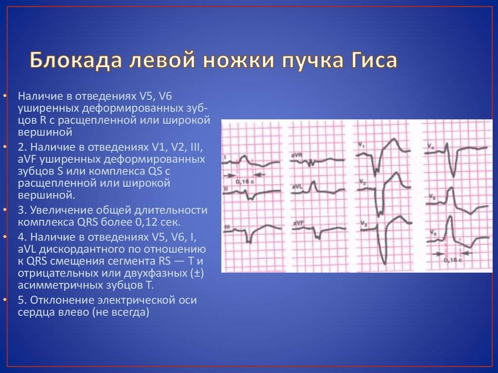Лечение неполной блокады правой ножки пучка Гиса у ребенка