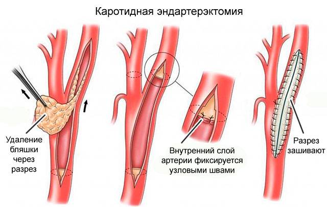 причины и симптомы стеноза периферических артерий