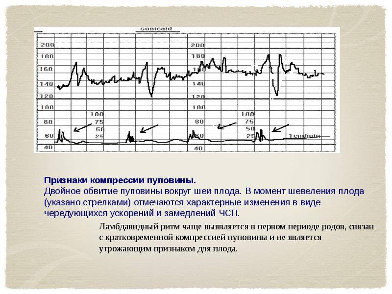 Что такое пренатальная КТГ?