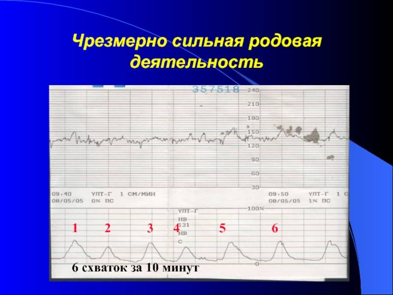 Что означает пик на КТГ?