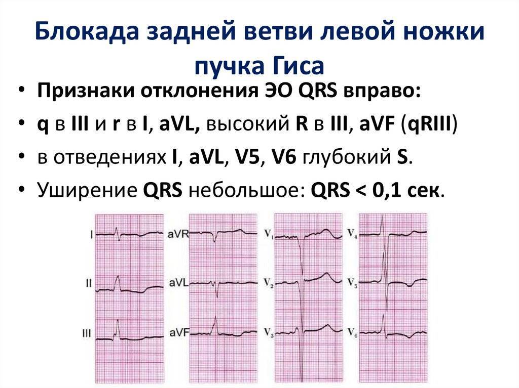 Нарушения сердечного ритма